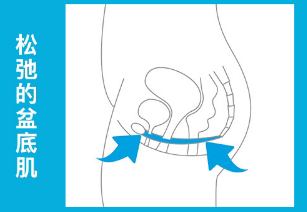 盆底肌修复